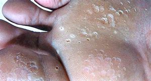 OIPMpYI4uwC23sIWgeSCroaSgHaD skin conditions feet